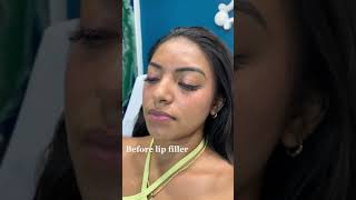 Stunning Lip Filler Transformation  Before amp After with Dr Dahabra in Florida shorts [upl. by Hanala]