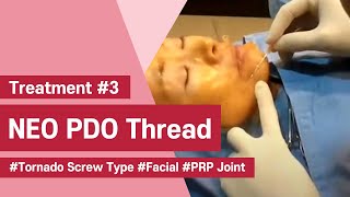 NeoGenesis Thread Series PDO Tornado Screw Type Facial Joint Procedure with PRP [upl. by Assi]