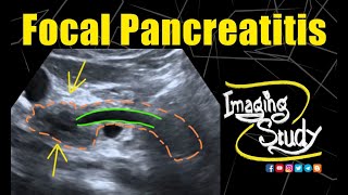 Focal Pancreatitis  Ultrasound  CT  Case 196 [upl. by Broek622]