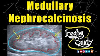 Medullary Nephrocalcinosis  Ultrasound  Case 128 [upl. by Orfield]