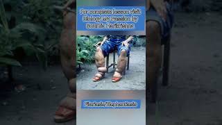 FILARIASIS shortsfeed healthNEET [upl. by Eiramait]