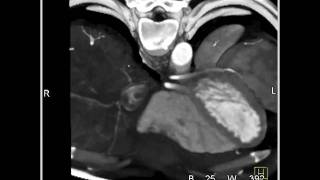 Cardiac Normal coronary CTA [upl. by Margaretta]