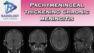 Pachymeningeal thickening Chronic meningitis [upl. by Assenev]