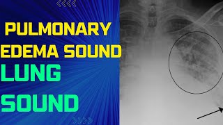 Pulmonary Edema Lung Sound Pulmonary Edema Sound Pulmonary Congestion [upl. by Haldi]