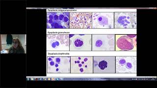 DES Hématologie 20202021  Syndromes myélodysplasiques 12 [upl. by Norb537]