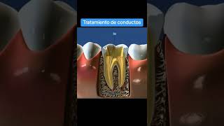 Endodoncia o tratamiento de conductos enfo dolordental parati fyp dientes odonto aprender [upl. by Nilrah]