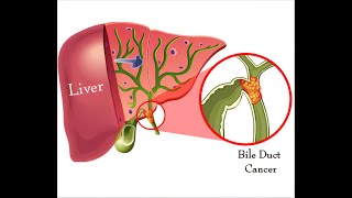 What Is Bile Duct Cancer [upl. by Rayle]