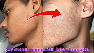 Minoxidil beard growth  2 month beard journey  transformation [upl. by Nolahs]