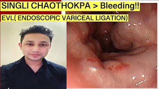 EVL Endoscoic Variceql Ligation Singli Chaothokpa Bleeding [upl. by Trista]