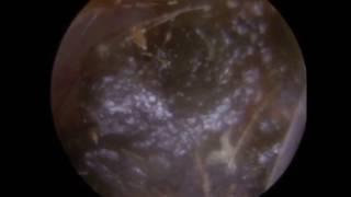 Ear Wax Extractions in Ear with Soft Ear Wax softened with Olive Oil Ear Wax Drops  Ep 290 [upl. by Xenophon]