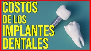 Todo sobre Implantes dentalesCuanto cuesta un implante dental [upl. by Rehctaht]