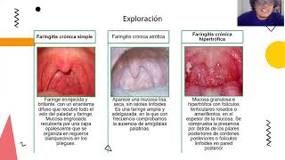 ¿Qué es la FARINGITIS CRÓNICA Las molestias contínuas de garganta ¿Tiene tratamiento [upl. by Ellenor284]