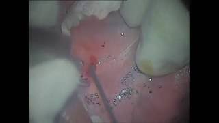 Dattas Submandibular Duct Stone removal [upl. by Bumgardner]