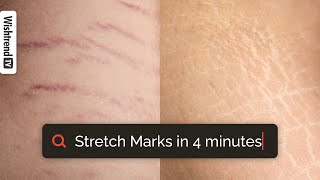 How To Get Rid Of Stretch Marks Ingredients that work for stretch marks  From Causes To Treatment [upl. by Carli]