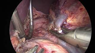 Laparoscopic adrenalectomy SwissMIS Berchtold [upl. by Htidirem]