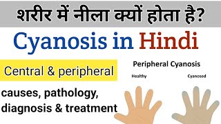 what is cyanosis  causes types amp treatment in Hindi [upl. by Anaihk]