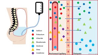 Peritoneal Dialysis [upl. by Eustatius]