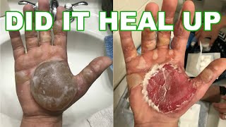 Second 2nd Degree Burn Treatment At Home How To Treat A Burn Blister At Home [upl. by Sarkaria500]