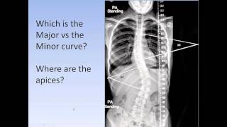 Scoliosis How to medically classify scoliosis the Lenke System for AIS [upl. by Cruickshank]