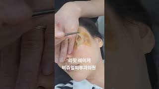 리팟 레이저 다발성 흑자 세종리팟 세종시리팟 reepot lentigo multiplelentigo 청주리팟 공주리팟 대전리팟 오창리팟 오송리팟 부여리팟 [upl. by Eveline]