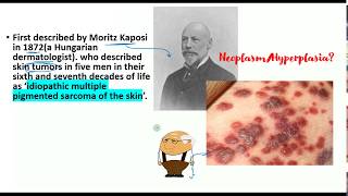 Kaposi Sarcoma lecture Pathogenesis clinical features histopathology EVERYTHING you need to know [upl. by Yesdnik]