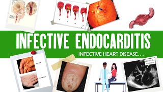 Infective Endocarditis  Dukes criteria  definition causes symptoms complications amp treatment [upl. by Alek213]