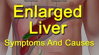 Enlarged Liver Symptoms And Causes  What Is Hepatomegaly [upl. by Eniad616]