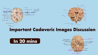 Neuroanatomy cadaveric image discussion  cadaveric cut section of brain  anatomy lectures medicos [upl. by Reifnnej208]