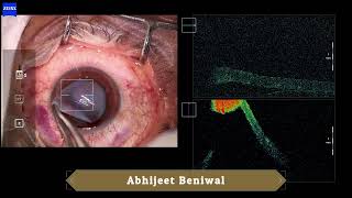 Automated Lamellar Therapeutic Keratoplasty ALTK [upl. by Aicirtel]