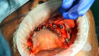 Palatal approachnaso maxillary butresspterygoid to avoid zygomatic implants for atrophic maxilla3 [upl. by Atel]