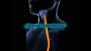 Que es la esofagitis esofagitis sintomas libre de gastritis [upl. by Kipp]