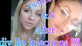 DIY LIP INJECTIONS AT HOME LIP FILLERS [upl. by Raynata]