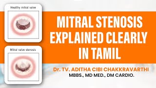 Mitral Stenosis Explained in Tamil [upl. by Georgy475]