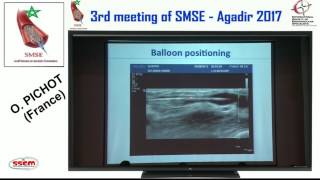 Angioplastie Echo guidée dans le traitement des complications des FAV [upl. by Ignacio]