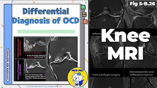 Fig 5B26 Differential Diagnosis of Osteochondritis Dissecans [upl. by Mariejeanne895]