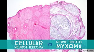 Cellular Neurothekeoma vs Nerve Sheath Myxoma  Dermpath Lookalikes [upl. by Nothgiel]