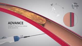 OUTBACK™ Elite ReEntry Catheter Product Highlights [upl. by Yeldarb31]