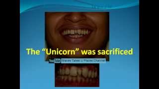 Extra tooth between front teeth  Fixed braces amp no teeth removed [upl. by Mimi]