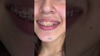 Braces Colors Before and after 8 weeks [upl. by Torrin852]