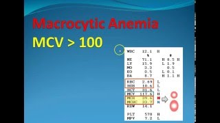 Hematology 2 Macrocytic Anemia [upl. by Dnomad703]