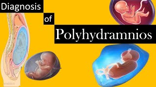 Diagnosis of Polyhydramnios [upl. by Deck]