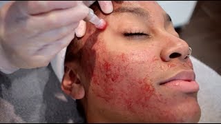 THE TRUTH ABOUT MICRONEEDLING  HOW I GOT RID OF MY ACNE SCARRING [upl. by Kirkpatrick]