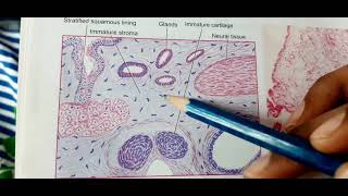 Teratoma Testicular Teratoma Revision MBBS PATHOLOGY [upl. by Monreal815]