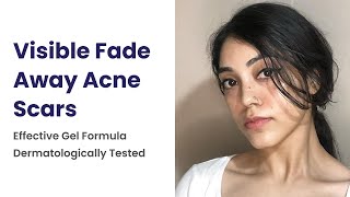 Visible Fade Away Acne Scars  Effective Gel Formula Dermatologically Tested [upl. by Coulombe752]