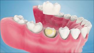 Dental Crown Procedure [upl. by Ecyrb283]