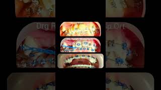 TRANSPOSISI CANINUS dan PREMOLAR PERTAMA RAHANG ATAS  Dental Needs  Jakarta Barat behelgigi [upl. by Zandt376]