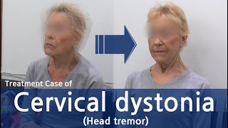 Cervical Dystonia Head tremor abdominal muscle tremors  사경증  근긴장이상증  치료사례 [upl. by Losse850]