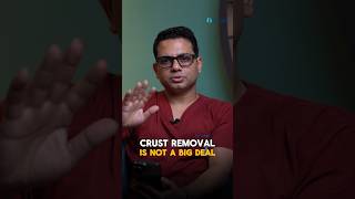 Is it safe to remove crusts at home  Explained by Dr Jangid [upl. by Ilojne]