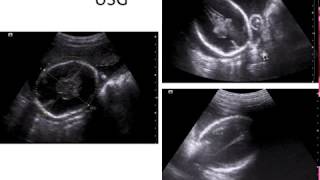 Fetal Hydranencephaly  What we need to know [upl. by Dominy405]