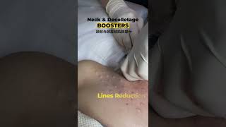 Neck and decolletage boosters✨ ｜DR D AESTHETICS CLINIC SINGAPORE [upl. by Anahcra]